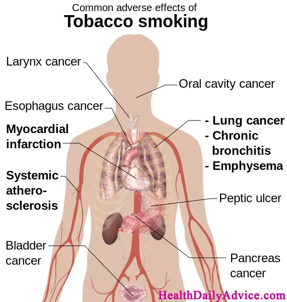 Tobacco Dependence 