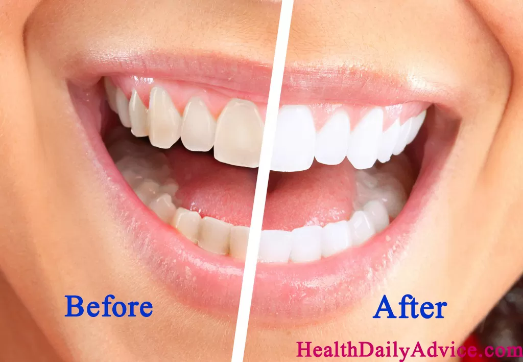 How to Whiten Your Teeth Naturally 