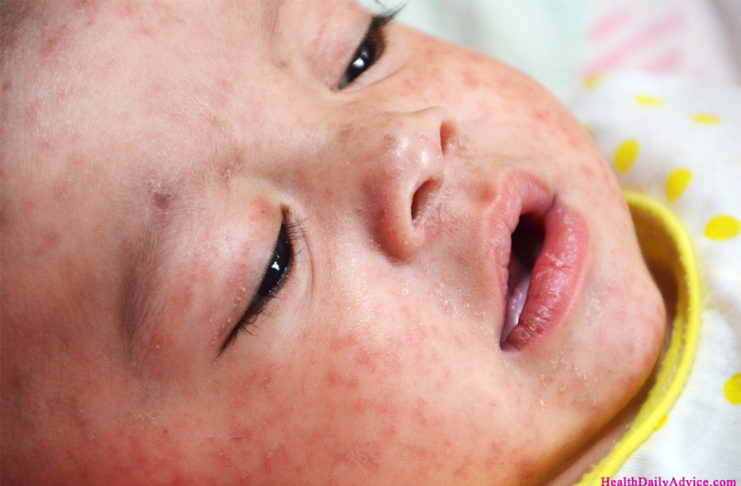 measles-rash-closeup