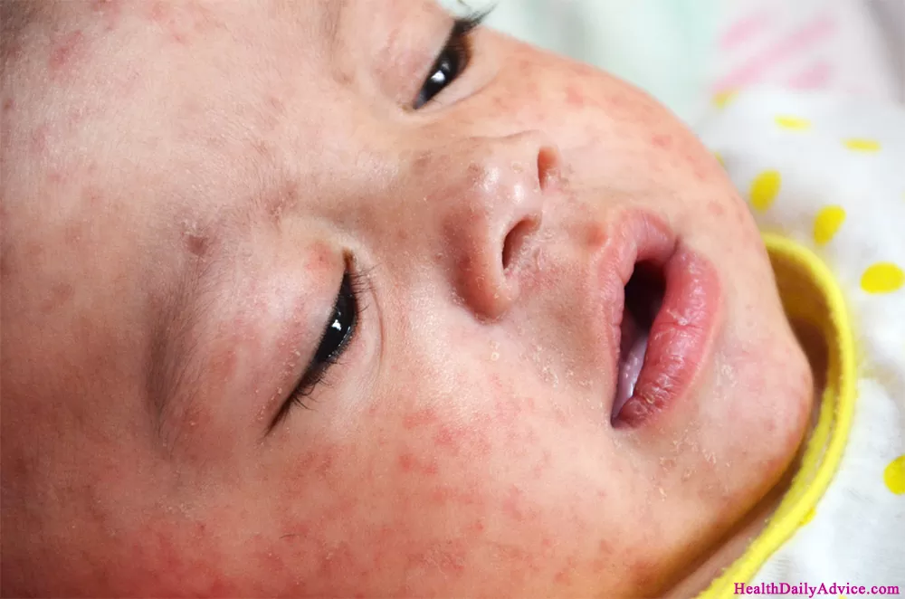 measles-rash-closeup