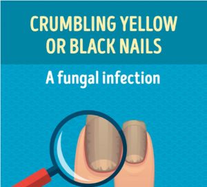 Crumbling Yellow or Black Nails