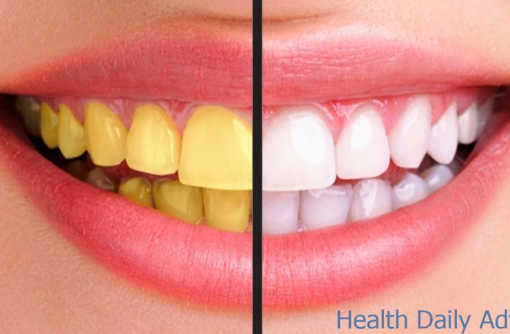 Why Do Teeth Turn Yellow