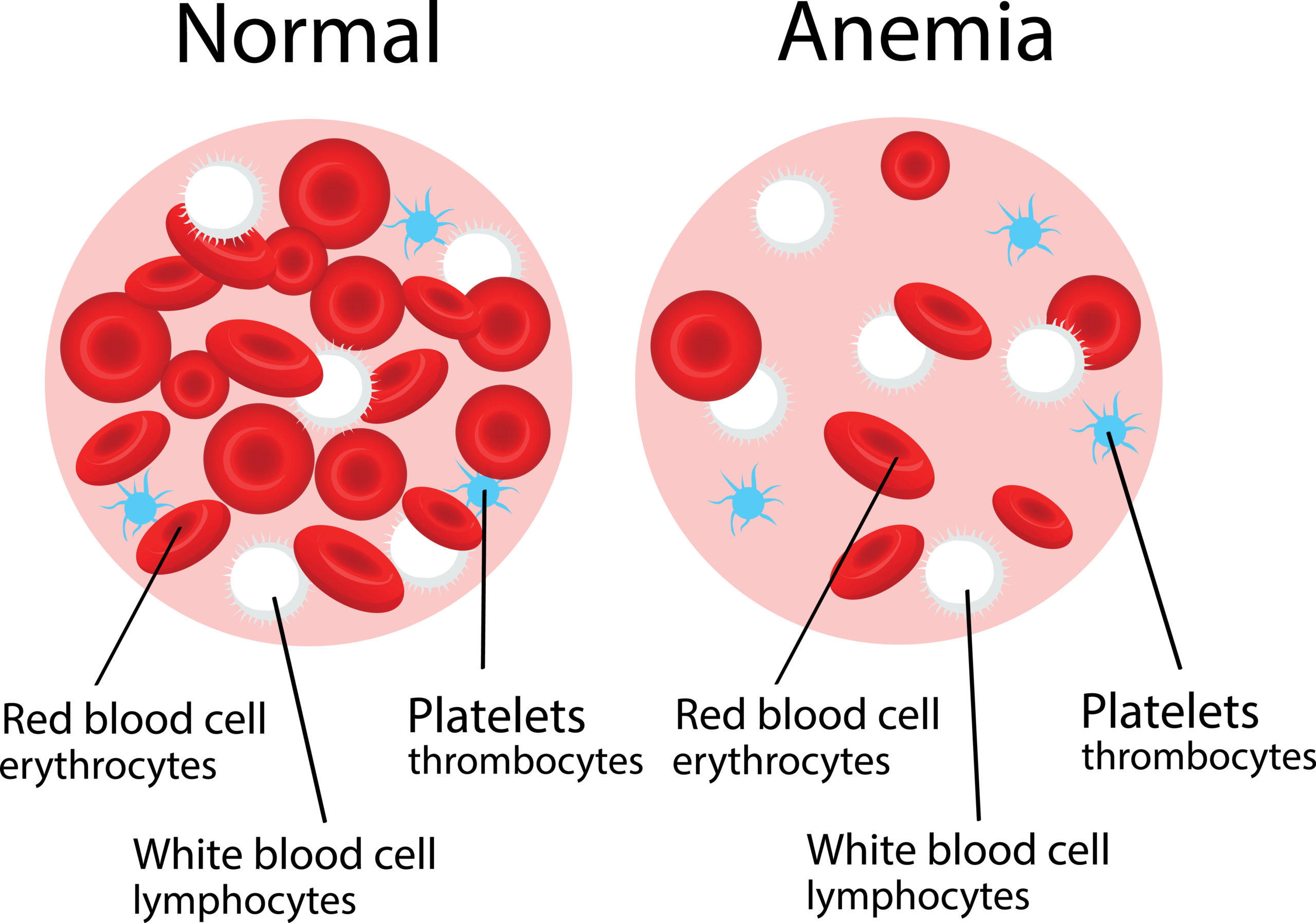Anemia - Causes, Symptoms, Treatments