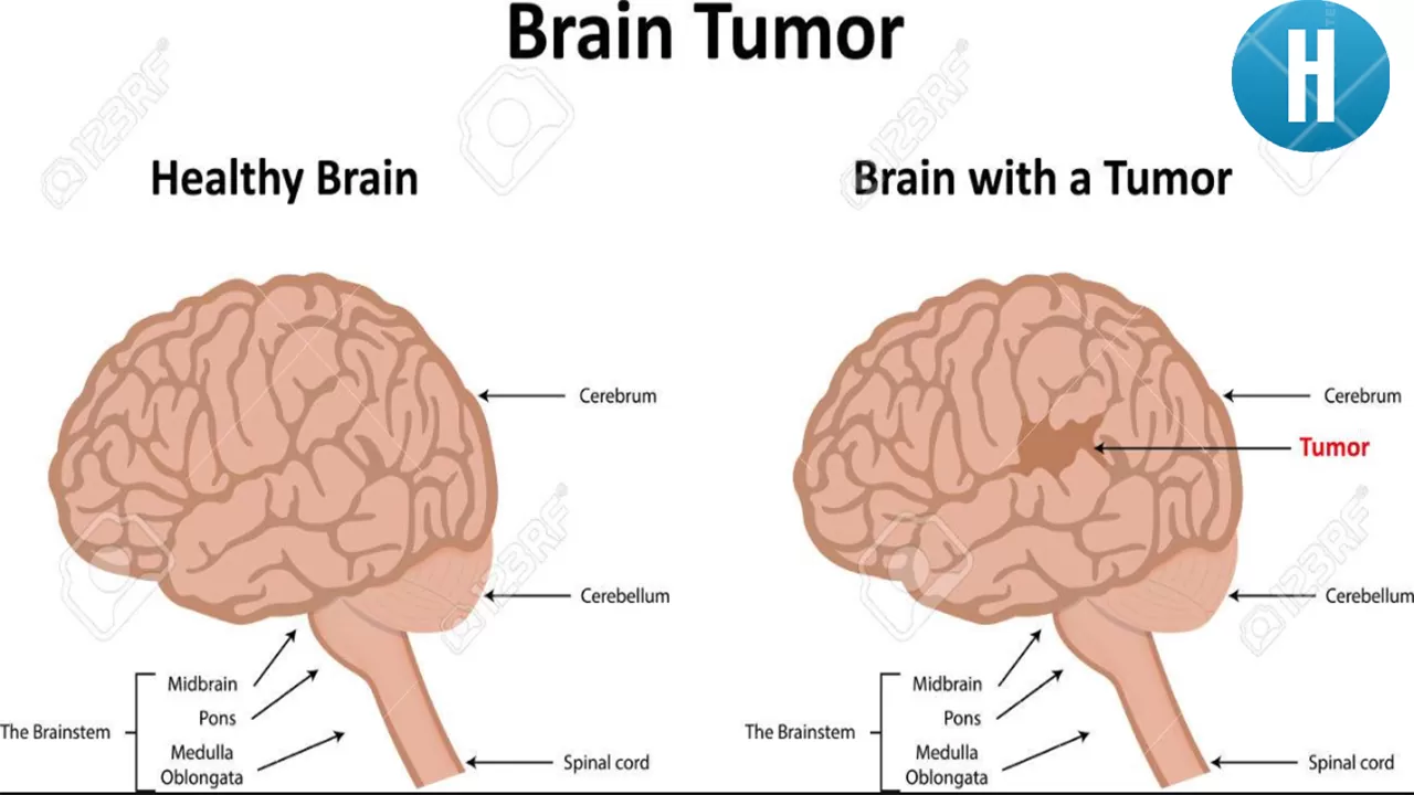 Sign and Symptoms of Brain Tumor