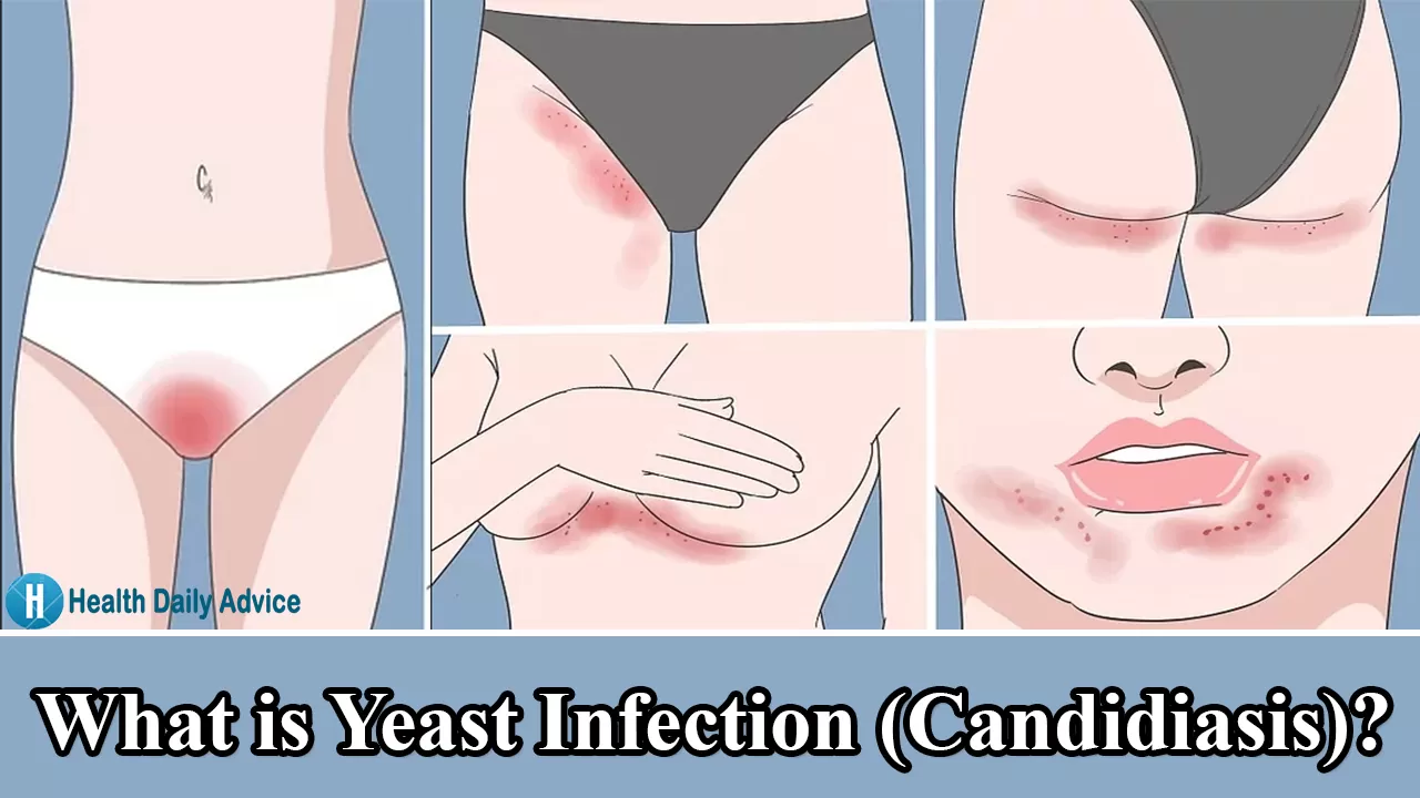 What is Yeast Infection (Candidiasis)