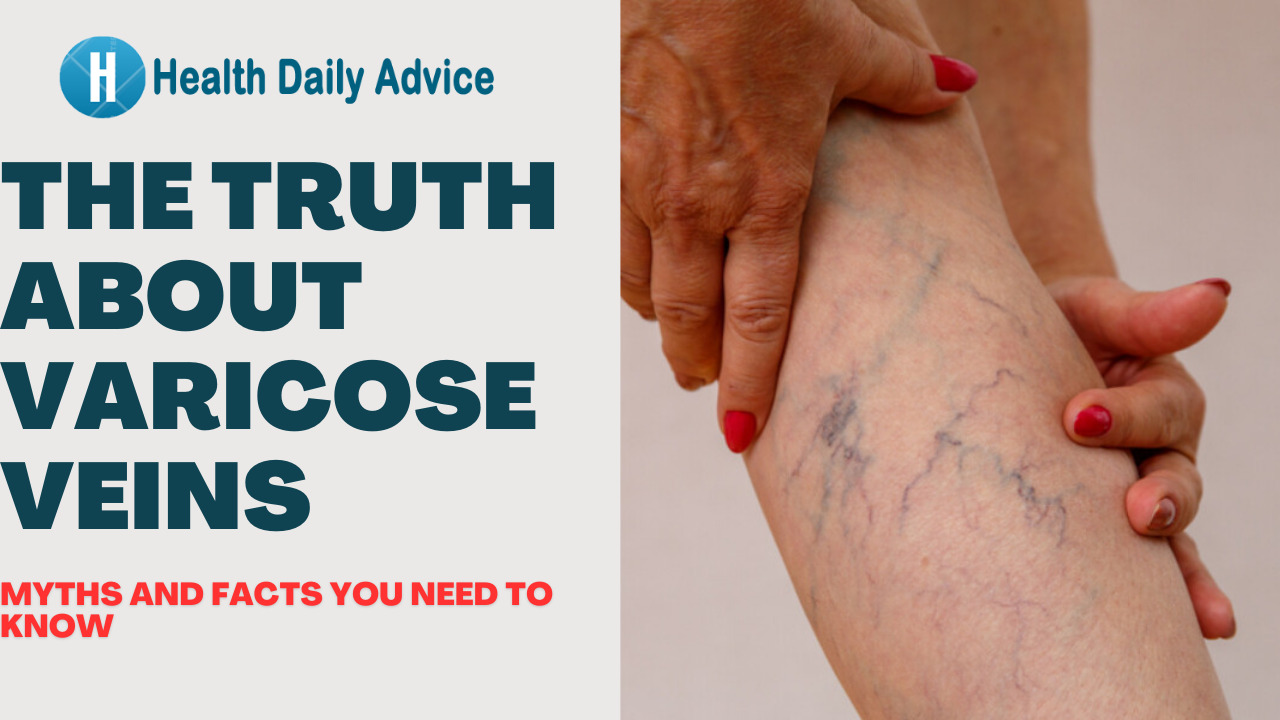 The Truth About Varicose Veins Myths and Facts You Need to Know