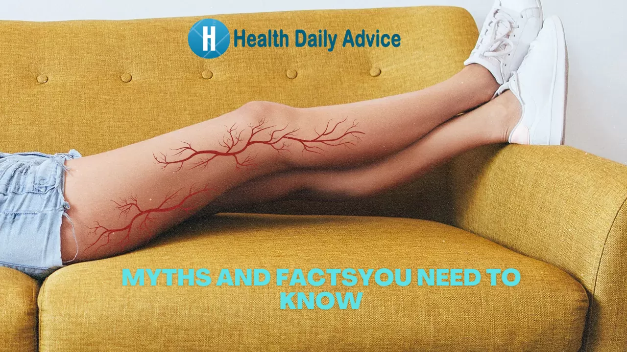 The Truth About Varicose Veins